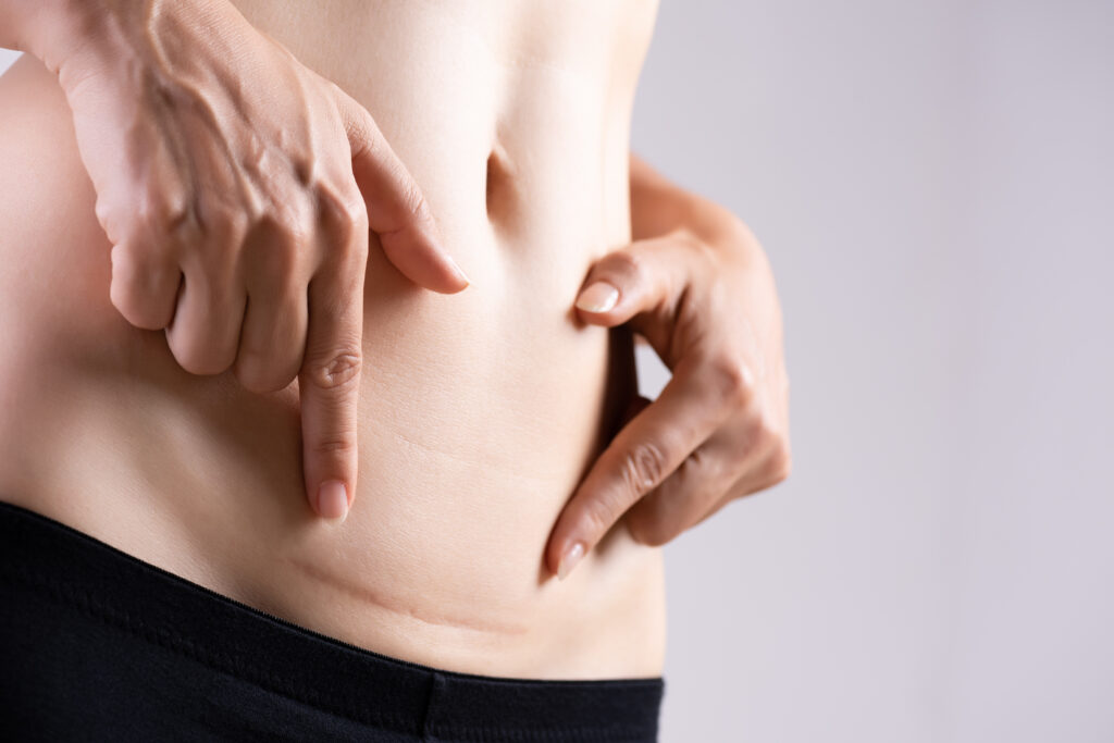 Endometriose na cicatriz da cesrea